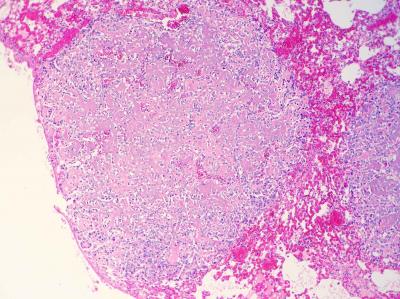 Imagen histológica de metástasis pulmonares de condrosarcoma en una cobaya