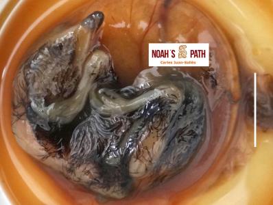 Malposición embrionaria (MPI cruzado dorsolateralmente por debajo de cuello)