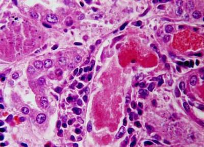 Necrosis renal tubular con cilindros de hemoglobina y nefritis - leptospirosis